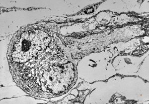M,15y. | rhabdomyoma - lip M,15y. | rhabdomyoma - lip